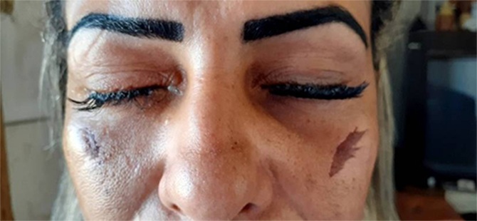 false eyelashes blind in one eye beauty salon botch-up