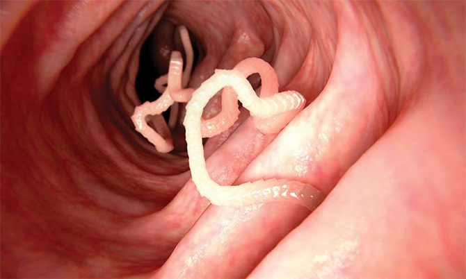 sushi giant tapeworm woman's stomach stale food