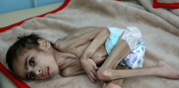 Yemen boy, ravaged by hunger, weighs 7 kg