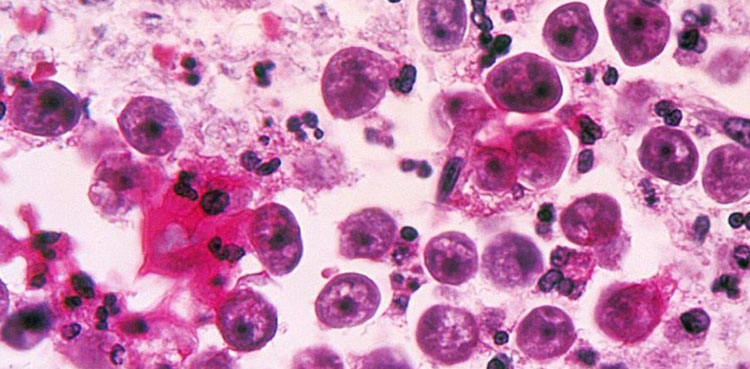 naegleria claims two lives karachi