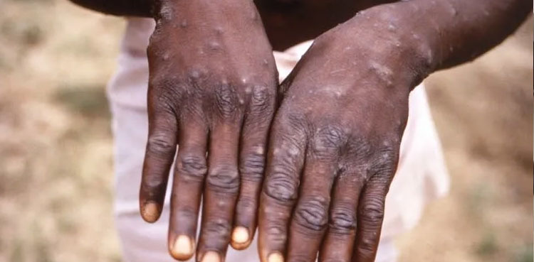 india monkeypox case