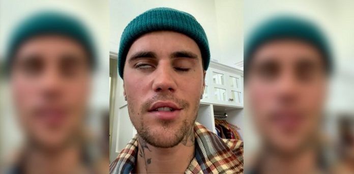 justin bieber facial paralysis, ramsay hunt syndrome