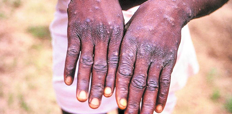 First monkeypox death, Africa, Brazil