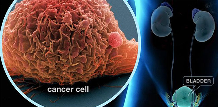Adstiladrin: US approves first gene therapy for bladder cancer