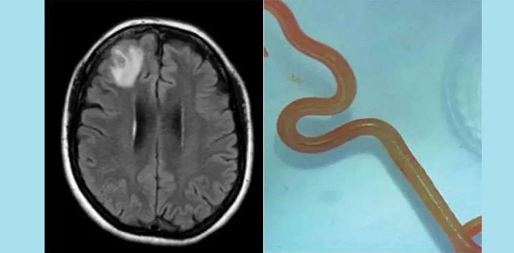 In a world-first, 8-cm parasite plucked from woman’s brain