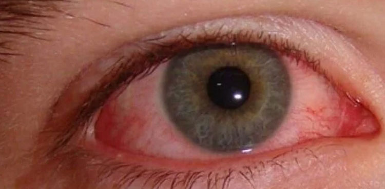 Pink eye infection, guidelines to airports, conjunctivitis