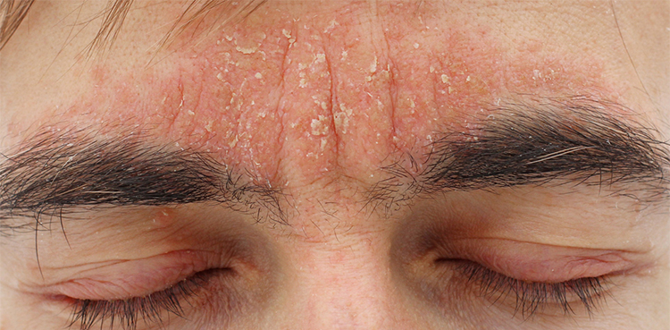 US skin disease seborrheic dermatitis